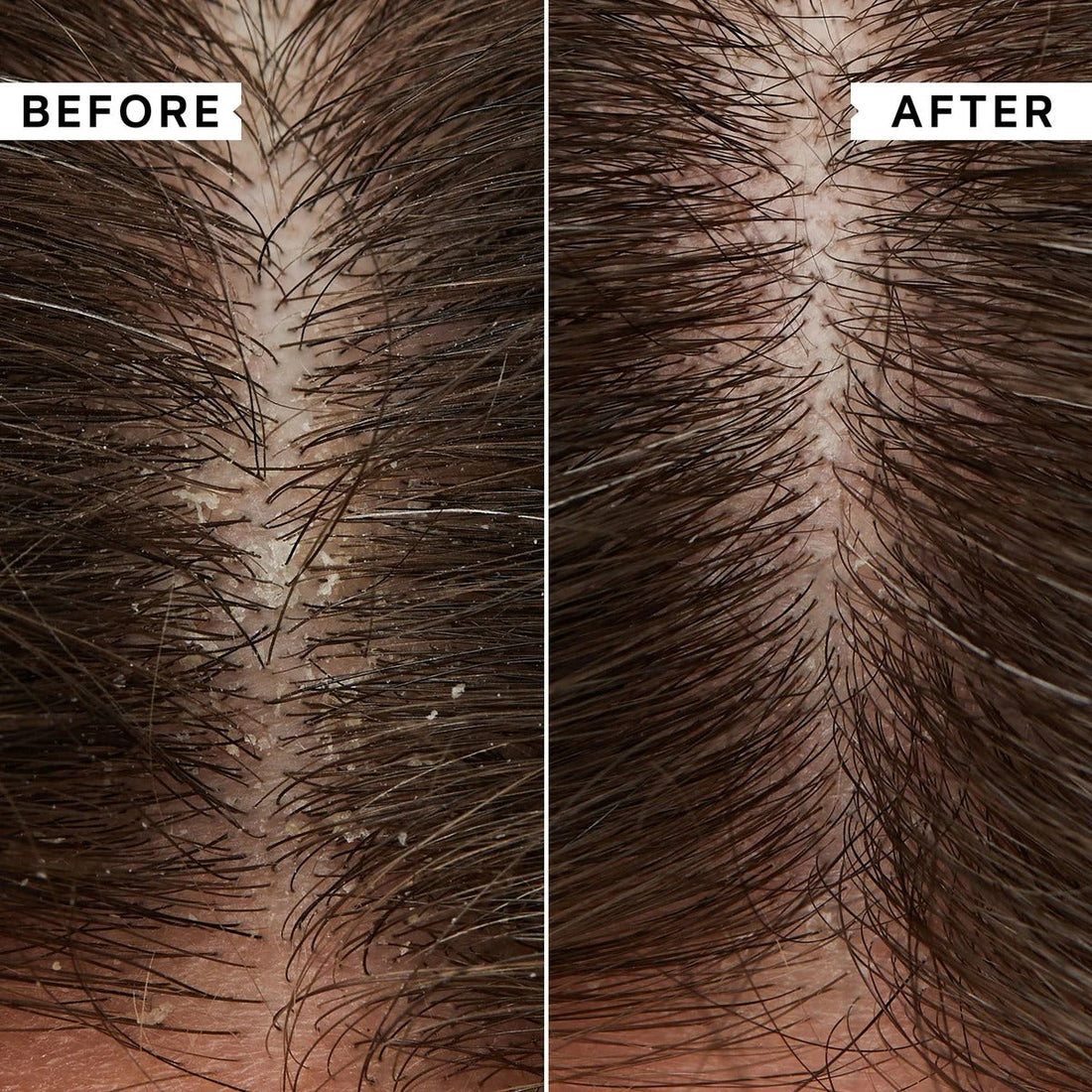 Struggling with Dandruff? How Scalp Massagers Can Help