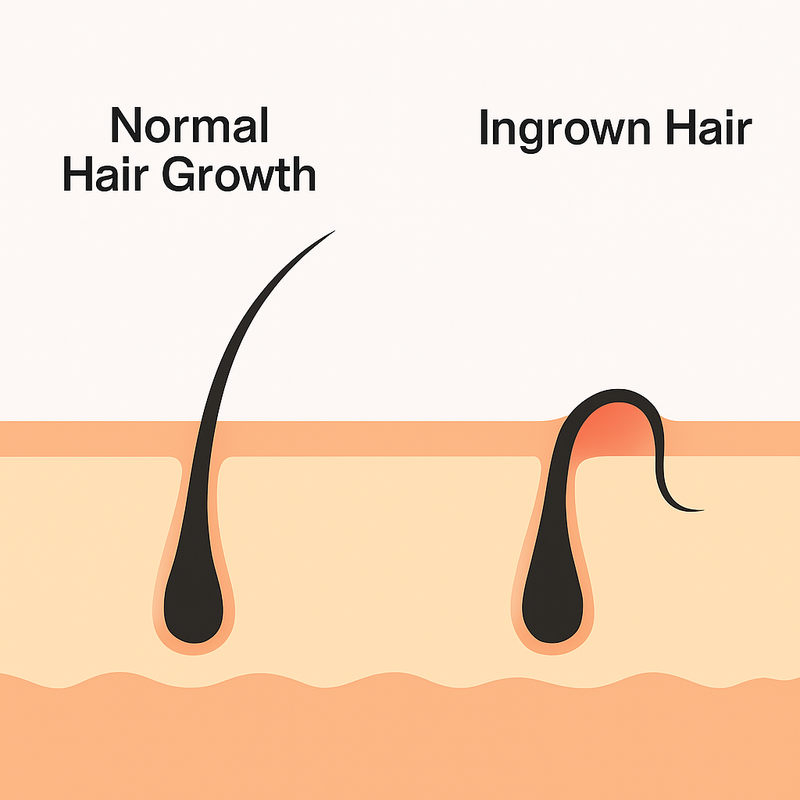 How to Get Rid of Ingrown Hairs: Your Complete Guide to Smooth Skin