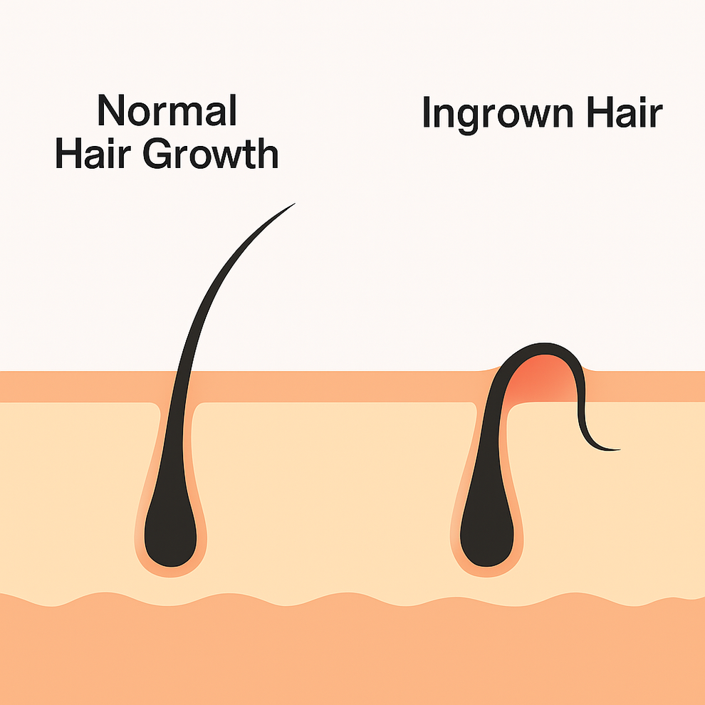 How to Get Rid of Ingrown Hairs: Your Complete Guide to Smooth Skin