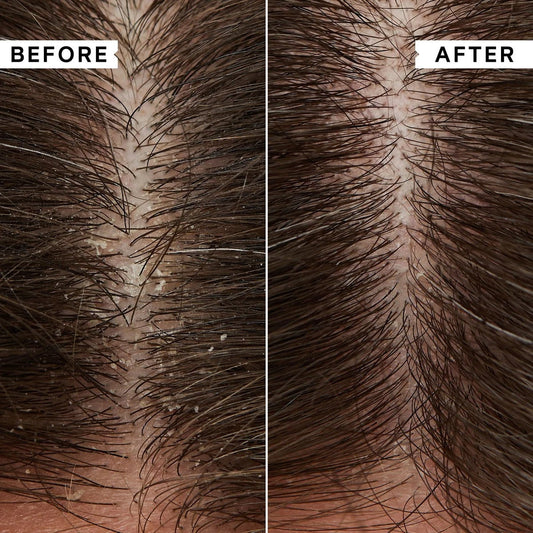 Struggling with Dandruff? How Scalp Massagers Can Help