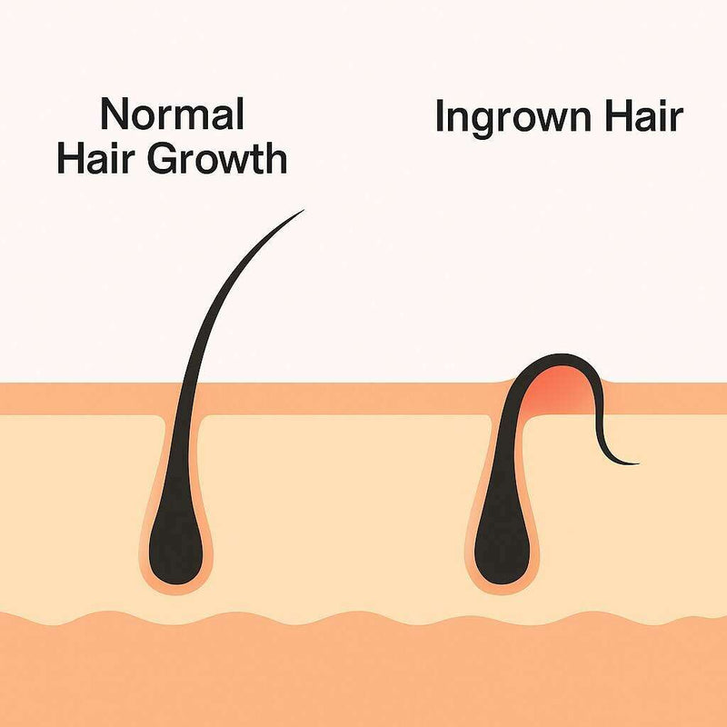 How to Get Rid of Ingrown Hairs: Your Complete Guide to Smooth Skin