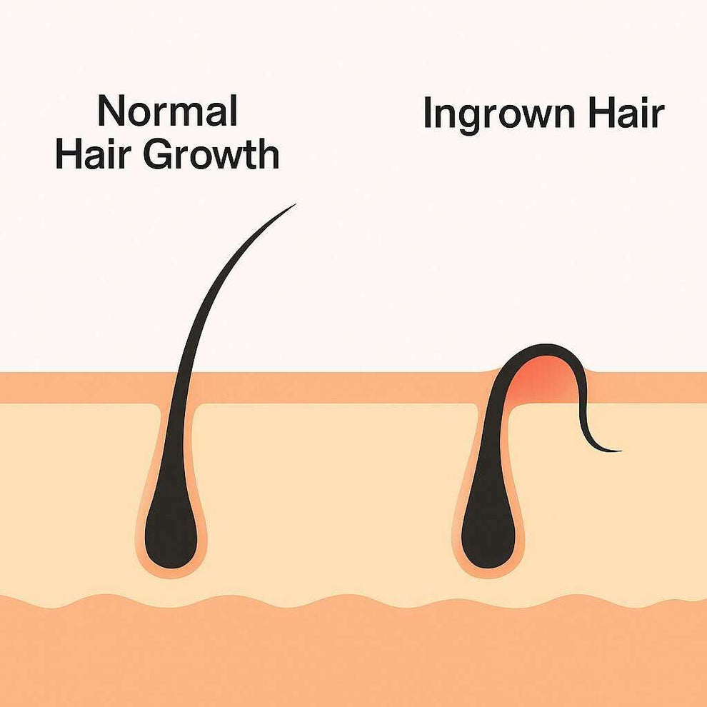 How to Get Rid of Ingrown Hairs: Your Complete Guide to Smooth Skin
